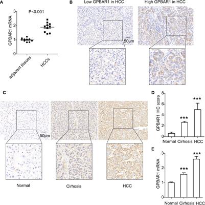 GPBAR1 is associated with asynchronous bone metastasis and poor prognosis of hepatocellular carcinoma